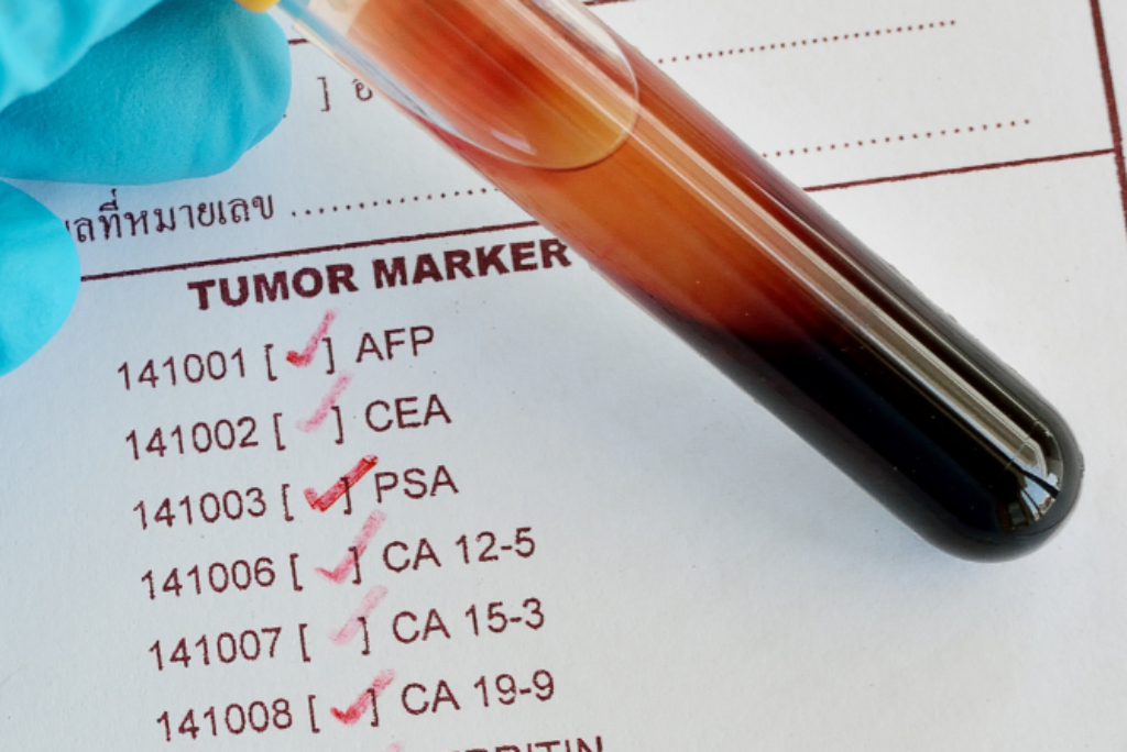 O que você precisa saber sobre o marcador tumoral CA125?